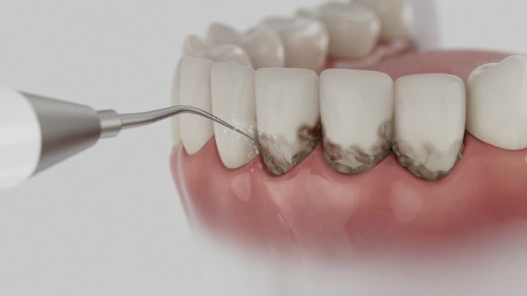 Trusted Dental Crowns And Bridges service in Park City, KS - Dentist Open Now